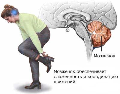 Нарушение зрительно моторной координации